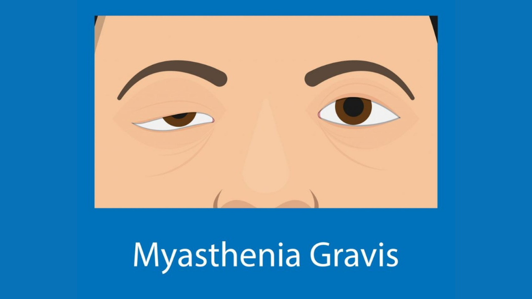 Myasthenia Gravis Support Group